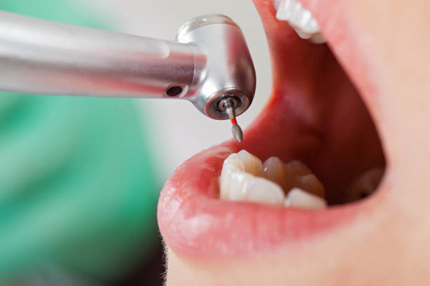 Best Emergency Wisdom Teeth Removal in Lexington, NE
